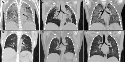 Case Report: Successful treatment of severe pneumocystis carinii pneumonia in a case series of primary nephrotic syndrome after receiving anti-CD20 monoclonal antibody therapy